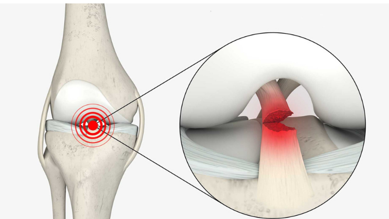 Diz Kapağı Ağrısının Nedenleri