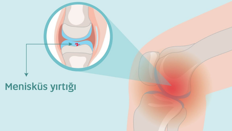 Menisküs Yırtığı Dereceleri: Hangi Aşamada Ne Yapılmalı?